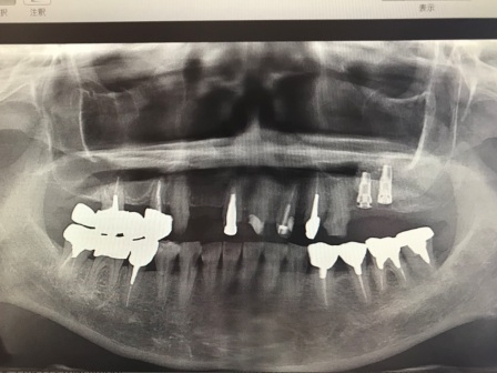インプラントのレントゲン写真