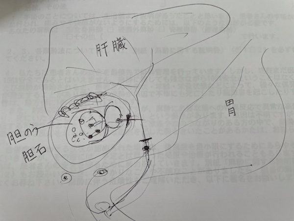 担当医師による手術箇所（胆嚢）の手書き説明​