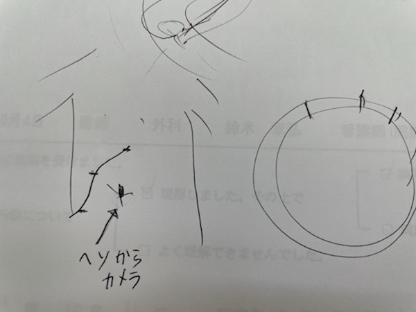 担当医師による腹腔鏡手術の穴開け挿入箇所​説明（手書き）